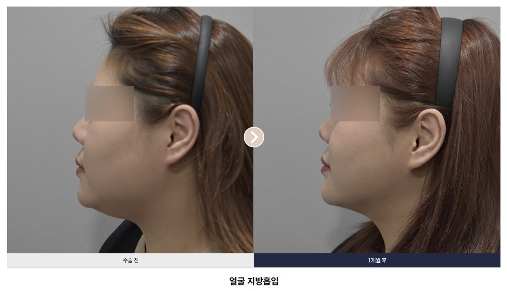 얼굴 지방흡입 전후 비교 Case 03