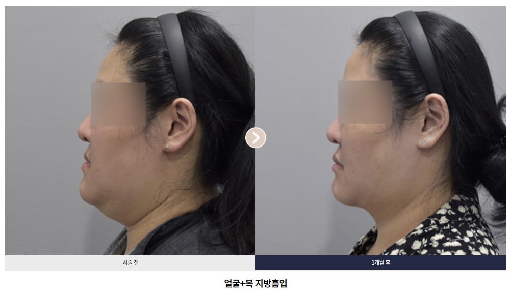 얼굴+목 지방흡입 전후 비교 Case 06