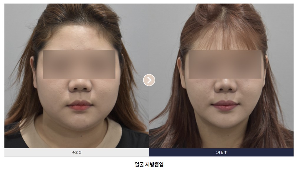 얼굴 지방흡입 전후 비교 Case 01