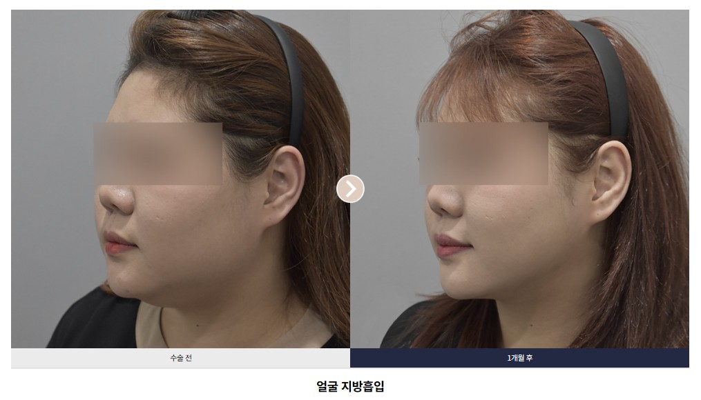얼굴 지방흡입 전후 비교 Case 02